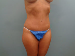 TUMMY TUCK BEFORE & AFTER PICTURES IN NASHVILLE, TN