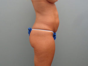 TUMMY TUCK BEFORE & AFTER PICTURES IN NASHVILLE, TN