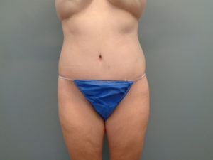 Tummy Tuck Before & After Pictures in Nashville, TN