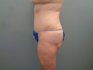 Tummy Tuck Before & After Pictures in Nashville, TN