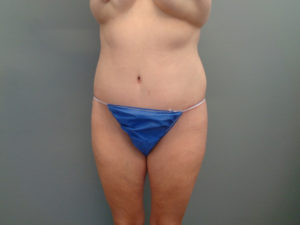 Tummy Tuck Before & After Pictures in Nashville, TN