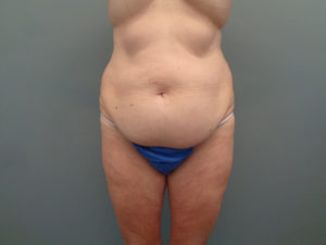 Tummy Tuck Before & After Pictures in Nashville, TN