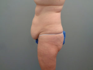 Tummy Tuck Before & After Pictures in Nashville, TN