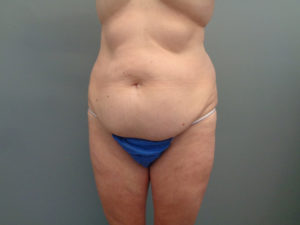 Tummy Tuck Before & After Pictures in Nashville, TN