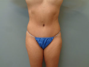 Tummy Tuck Before & After Pictures in Nashville, TN