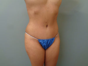 Tummy Tuck Before & After Pictures in Nashville, TN