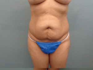 Tummy Tuck Before & After Pictures in Nashville, TN