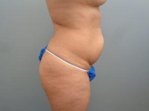 Tummy Tuck Before & After Pictures in Nashville, TN