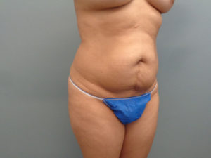 Tummy Tuck Before & After Pictures in Nashville, TN