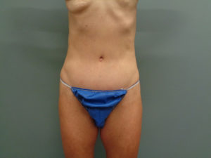 Tummy Tuck Before & After Pictures in Nashville, TN