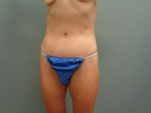 Tummy Tuck Before & After Pictures in Nashville, TN