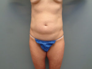 Tummy Tuck Before & After Pictures in Nashville, TN