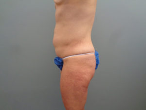 Tummy Tuck Before & After Pictures in Nashville, TN