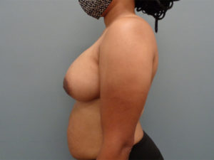 Breast Augmentation Before & After Pictures in Nashville, TN