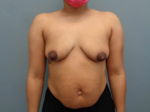 Breast Augmentation Before & After Pictures in Nashville, TN