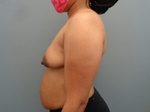 Breast Augmentation Before & After Pictures in Nashville, TN