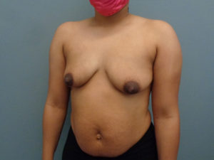 Breast Augmentation Before & After Pictures in Nashville, TN