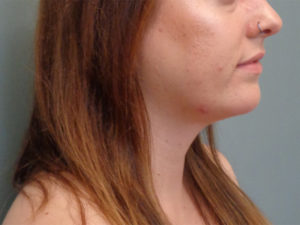 Chin Augmentation Before & After Pictures in Nashville, TN