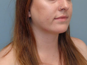 Chin Augmentation Before & After Pictures in Nashville, TN