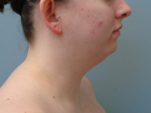 Chin Augmentation Before & After Pictures in Nashville, TN