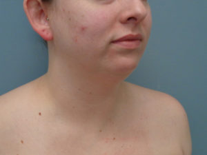 Chin Augmentation Before & After Pictures in Nashville, TN