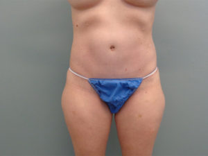 Tummy Tuck Before & After Pictures in Nashville, TN