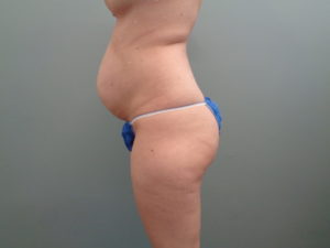 Tummy Tuck Before & After Pictures in Nashville, TN