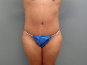 Tummy Tuck Before & After Pictures in Nashville, TN