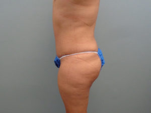 Tummy Tuck Before & After Pictures in Nashville, TN