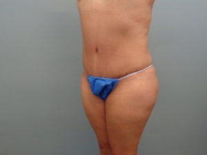 Tummy Tuck Before & After Pictures in Nashville, TN