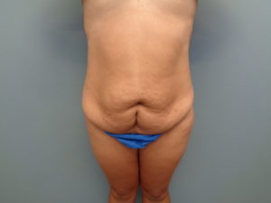 Tummy Tuck Before & After Pictures in Nashville, TN