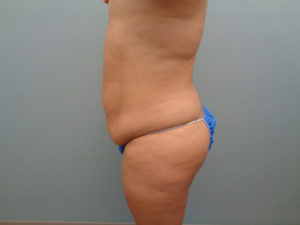 Tummy Tuck Before & After Pictures in Nashville, TN