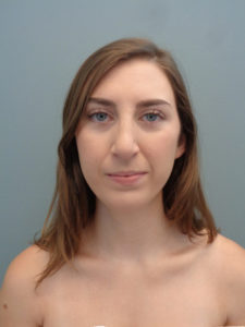 Rhinoplasty Before & After Pictures in Nashville, TN