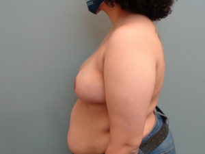 Breast Reduction Before & After Pictures in Nashville, TN
