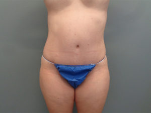 Tummy Tuck Before & After Pictures in Nashville, TN