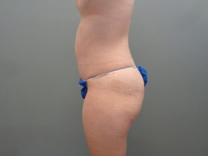 Tummy Tuck Before & After Pictures in Nashville, TN