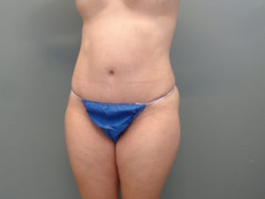 Tummy Tuck Before & After Pictures in Nashville, TN