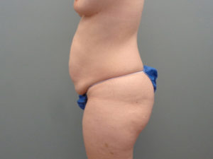 Tummy Tuck Before & After Pictures in Nashville, TN