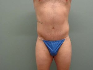 Body Lift Before & After Pictures in Nashville, TN