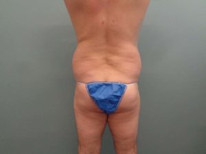 Body Lift Before & After Pictures in Nashville, TN