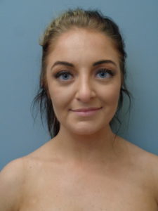 Rhinoplasty Before & After Pictures in Nashville, TN