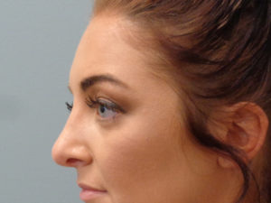 Blepharoplasty Before & After Pictures In Nashville, TN