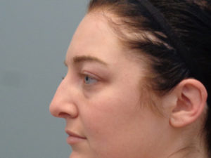 Blepharoplasty Before & After Pictures In Nashville, TN