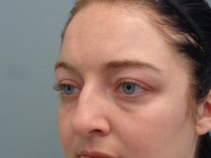 Blepharoplasty Before & After Pictures In Nashville, TN