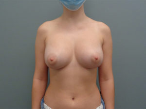 Breast Augmentation Before & After Pictures in Nashville, TN