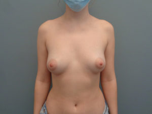 Breast Augmentation Before & After Pictures in Nashville, TN