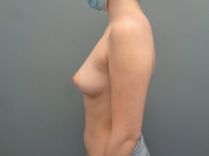 Breast Augmentation Before & After Pictures in Nashville, TN