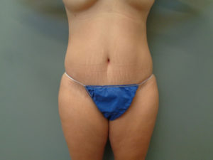 Tummy Tuck Before & After Pictures in Nashville, TN