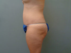 Tummy Tuck Before & After Pictures in Nashville, TN