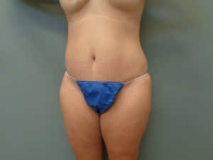 Tummy Tuck Before & After Pictures in Nashville, TN